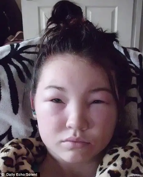 dye allergy leaves uk girl chole robins with double-sized face