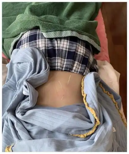 钟楚曦晒针灸近照表露腰韧带损伤,趴在床上不能动弹引粉丝担心