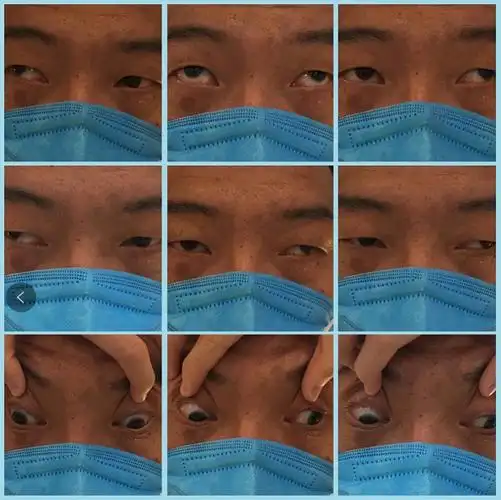 疑难斜视遇上眼球震颤30岁男子在普瑞眼科解决顽疾重拾自信