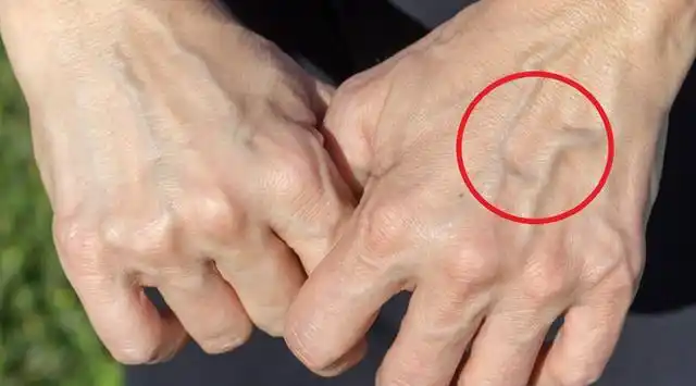 为何有些人手臂上"青筋凸起",有的人却并不明显?医生来解答!