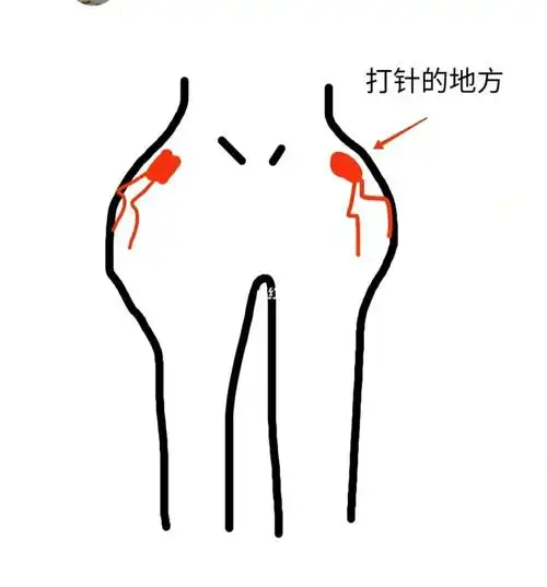 打屁股针好疼啊,疼死老娘了,两边各一针,一边没感觉,一边疼得想哭