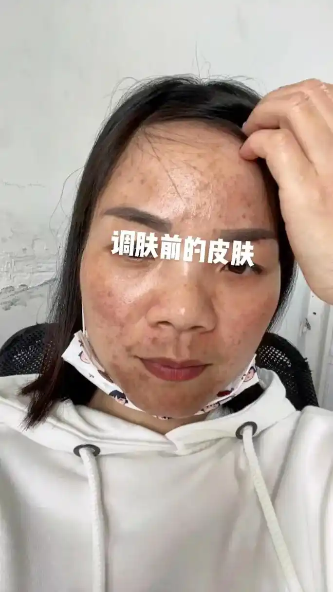 美女之前的皮肤自己都不想照镜子满脸的闭口痘痘痘印黄褐斑没一块皮肤