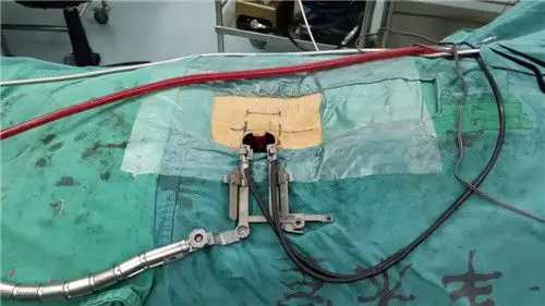 于2009年率先在天津市开展经皮椎弓根螺钉内固定术治疗椎体压缩性骨折