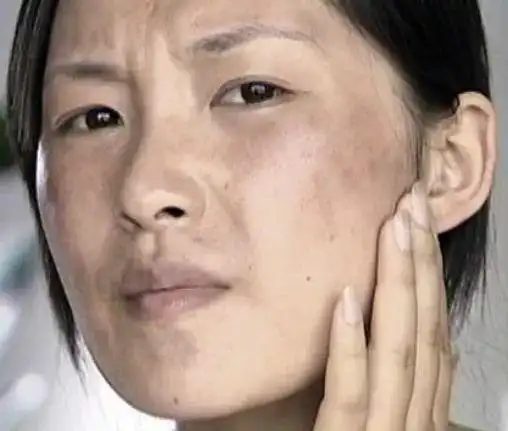 皮肤粗黑暗黄爱长斑的姐妹对照自查看体内哪里出了问题