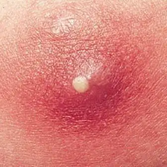 外阴疖肿手术大概多少钱