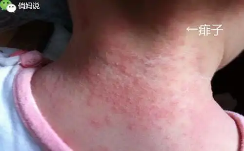 宝宝长痱子,淹脖子怎么办?其实3块钱就可以搞定