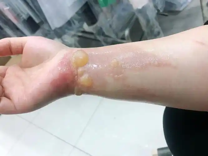 浅二度油烫伤之后的皮肤变化过程