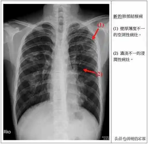 肺结核皮试肺结核应该检查哪几项
