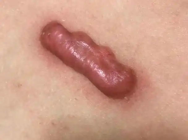 加上经验不足没有好好护理,疤痕出现了严重的增生问题,不仅泛红凸起还