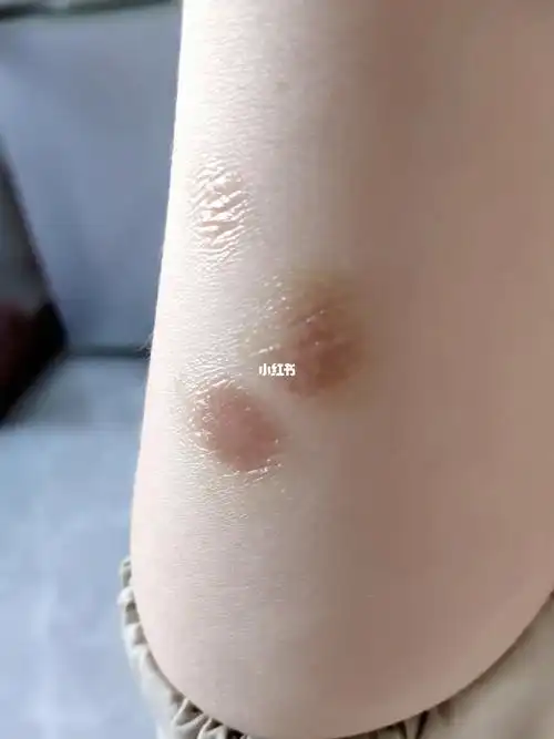 烫伤涂药第三天