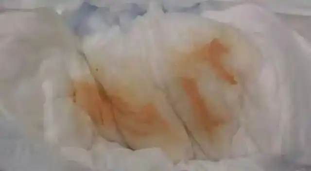 女婴诞生没几日,宝妈发现纸尿裤上一片红,愣住了!