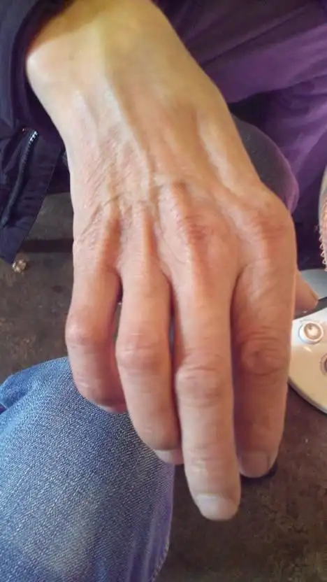 手上的肌肉大部分萎缩,小指和无名指特别痛,已经有三年了,食指和拇指