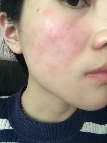 敏感肌三天脱敏. 这次烂脸是看小红书上说地奈德乳膏可以治疗过敏.