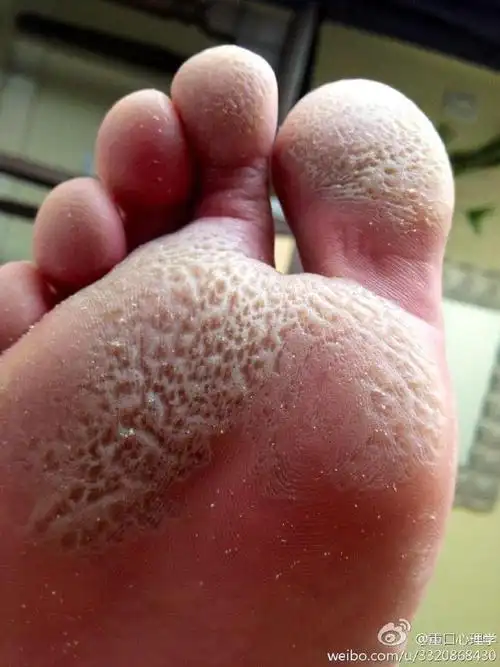 比臭脚更恶心比烂脚丫更可怕足跖蠹蚀症