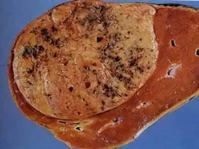 原发性肝癌的鉴别诊断