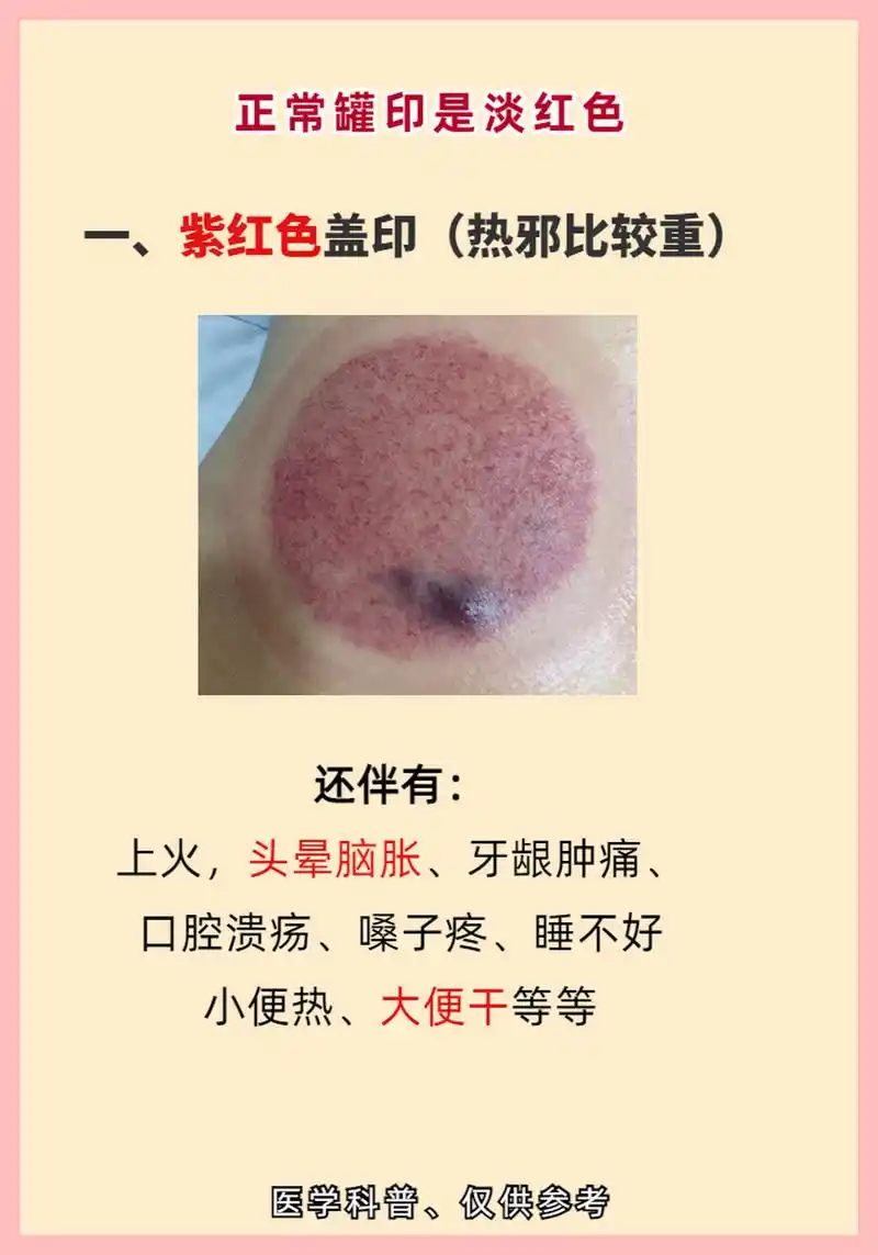 拔罐真的能治病?拔出来黑,紫,青,红各色的罐印都说明什么?