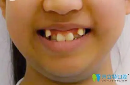 12岁女儿在福州中泽口腔做虎牙矫正1年,牙齿和脸型都变了.