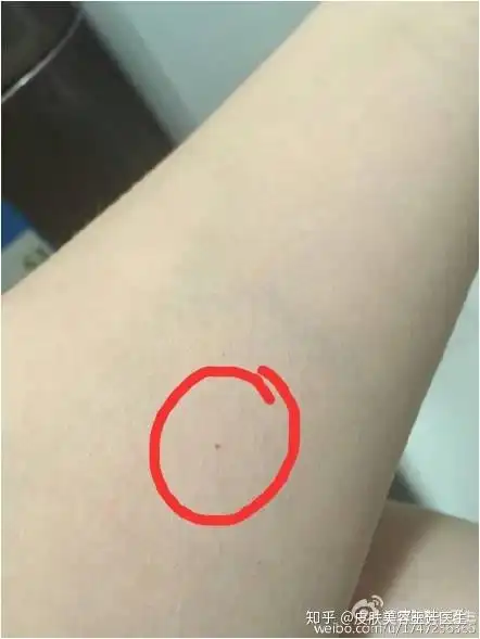 今天讲一讲最常见的一种血管瘤樱桃样血管瘤