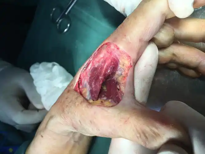 一例皮肤恶性肿瘤,左手虎口处肿物渐进性增大伴反复溃烂3年,入院初步