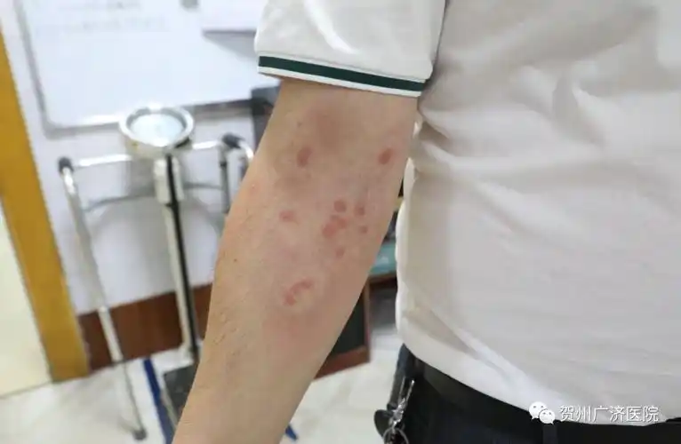 红蚂蚁又出来伤人了!贺州已收治多名被咬休克者!_症状
