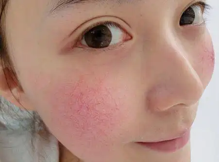 管理方法:mts再生管理,超声刀,木乃伊焕肤,天鹅绒焕肤,巧克力焕肤等.