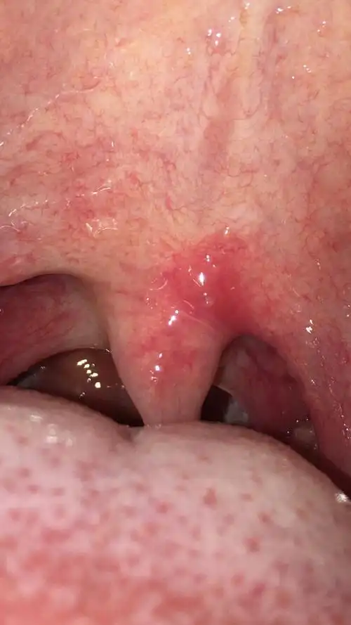 吃快卖榨菜肉丝,吃一半突然感觉口腔很痛,照片拍下来发现小舌头一边