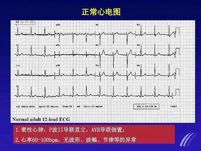 心电图～心律失常图谱的简单认识