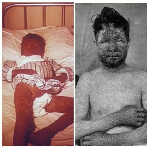 小孩得天花病毒图片