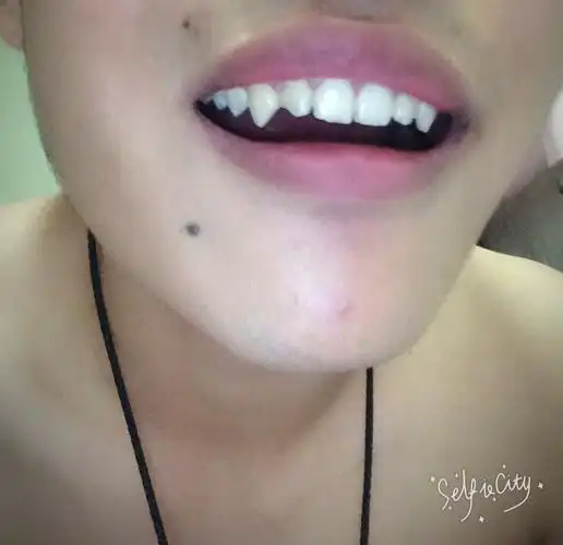 为什么我的牙齿很尖?是不是长歪了?我用不用矫正或者磨平?急