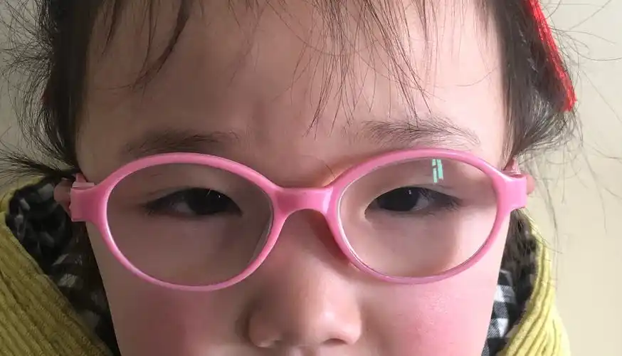 斜视如何治疗呢?