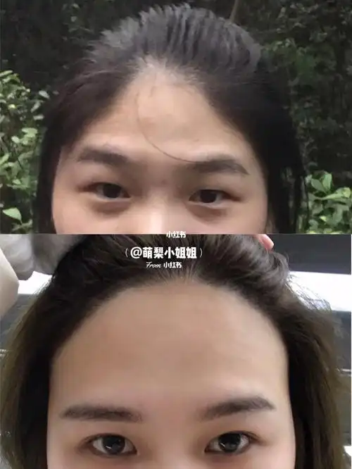 脱发际线,终于摆脱了我的三角形短额头_脱发_眉毛_修眉刀_脱毛_发际线