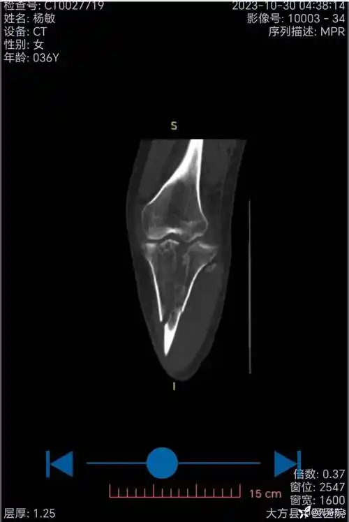 陈旧性胫骨平台骨折