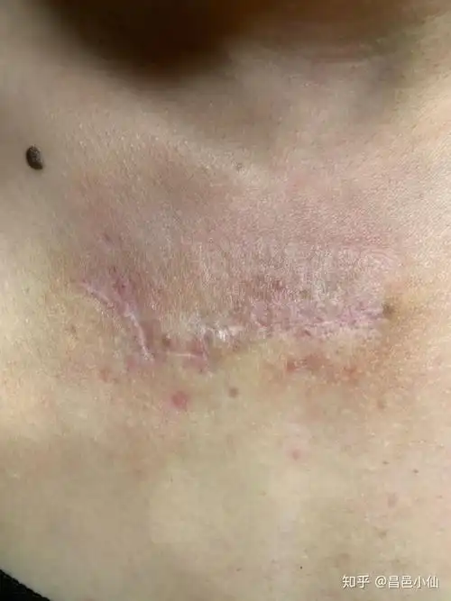 瘢痕疙瘩手术记录