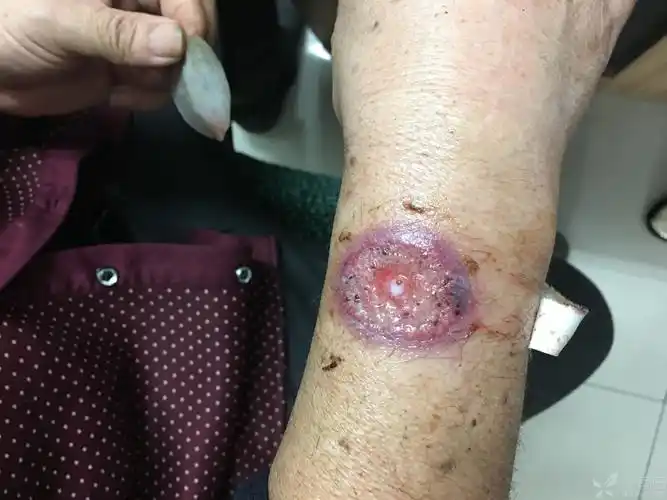 相关疾病: 坏疽性脓皮病 肺癌老年男性.