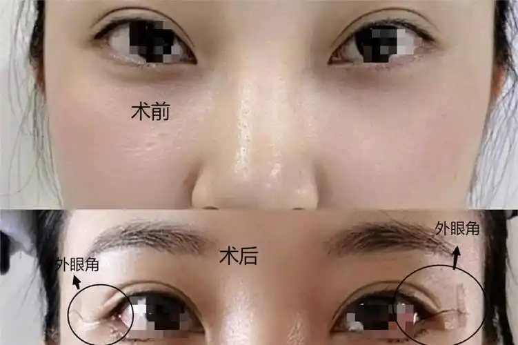 开外眼角前后对比图