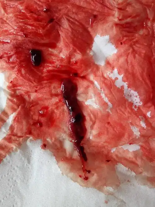 我有更好的答案 1条回答  这个是月经期子宫内膜组织和血液混合形成的