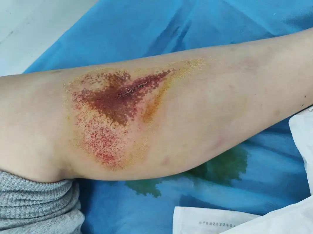 距离女儿被摩托车撞飞受伤,短短12天,伤口的愈合还是挺快的. - 抖音