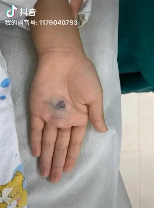 手部静脉畸形(海绵状血管瘤)介入治疗_海绵状血管瘤