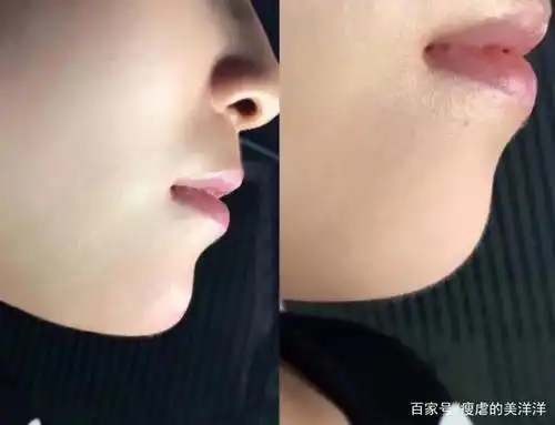 下颌线不清晰不一定因为胖!