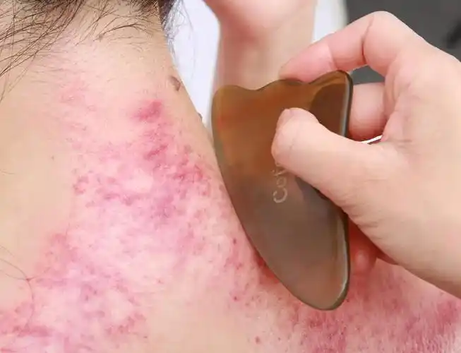 女人经常刮痧,原来有这么多的好处!