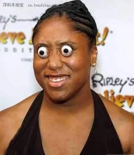 间歇性眼球突出症