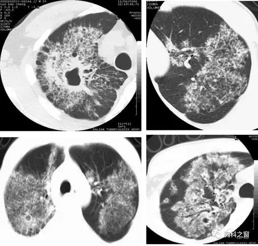 肺结核的薄层ct征象树芽型的病理意义