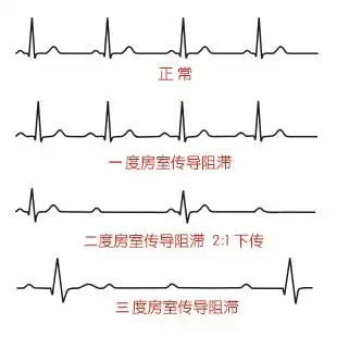 看心电图揪拦路虎谈谈房室传导阻滞