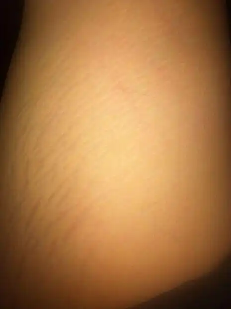 橘皮纹(肥胖纹,膨胀纹)影响公务员体检吗(是警察体检,要求可能较严)有