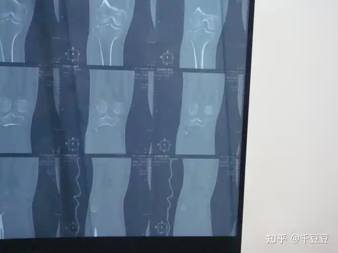 胫骨平台塌陷ct图片