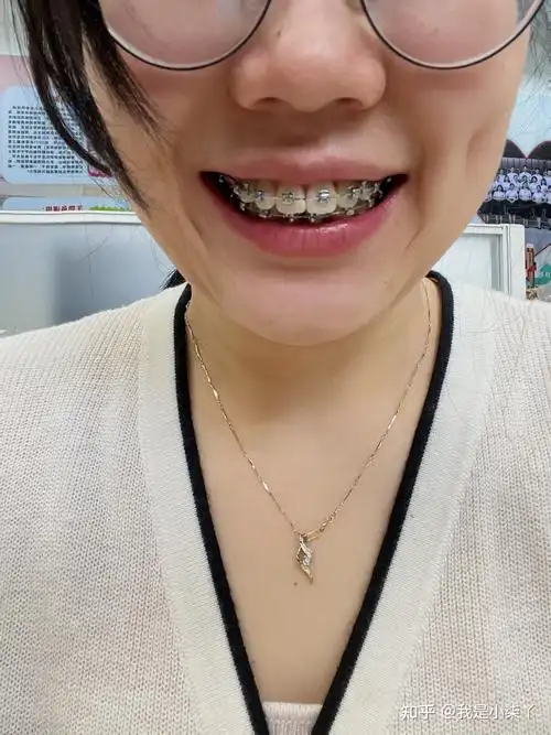 28岁小龅牙的整牙之旅 - 知乎