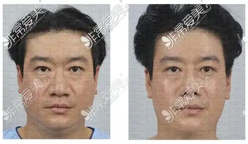 男士隆鼻鼻翼缩小面吸前后对比图片