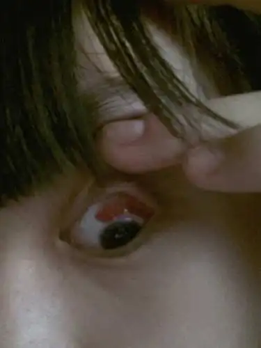 我的眼白上有大块血块,无痛无感,以前都没有出现过.