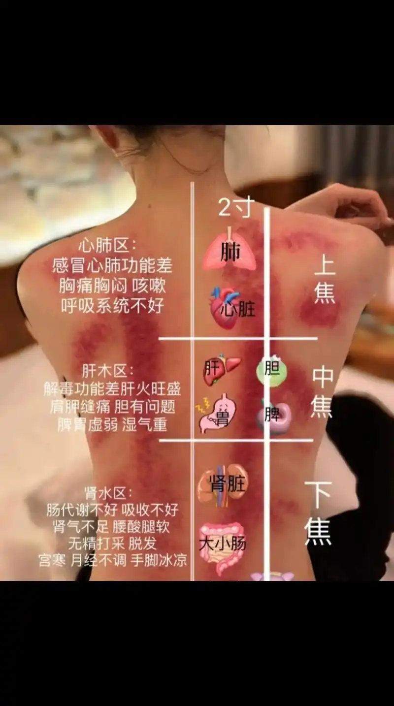 出痧的部位就是脏腑反射区…… 人体中最大的反射区在背部