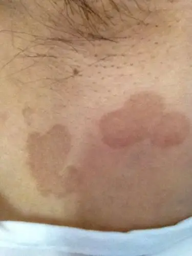 我腋窝下长了这时什么?两边都有,大小不等,去年冬天就有了